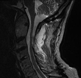 Cervical Post op Abscess